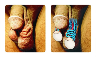 Illustration for article titled Obat Herbal Alami Varikokel